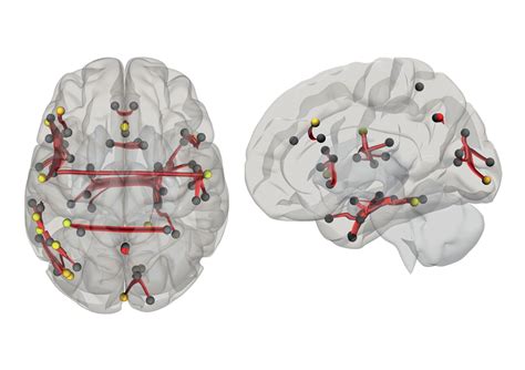 Une thérapie améliore les fonctions cognitives chez des patients