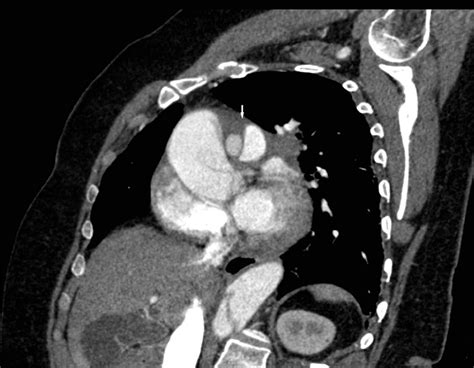 Computed Tomography Angiography Of The Chest Showing A Stanford Type A