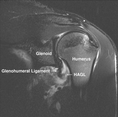 traumatic shoulder dislocation  combined bankart lesion  humeral