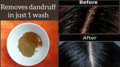 How To Remove Dandruff Naturally In Just Wash Youtube