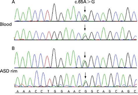 The Nkx2 5 Heterozygous Sequence Variant C65ag Q22r The Missense