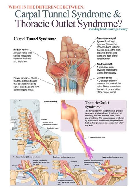 Carpal Tunnel Syndrome | Energise Therapy