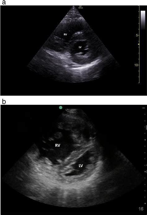 Focused Cardiac Ultrasound To Expedite Diagnosis Of Pulmonary