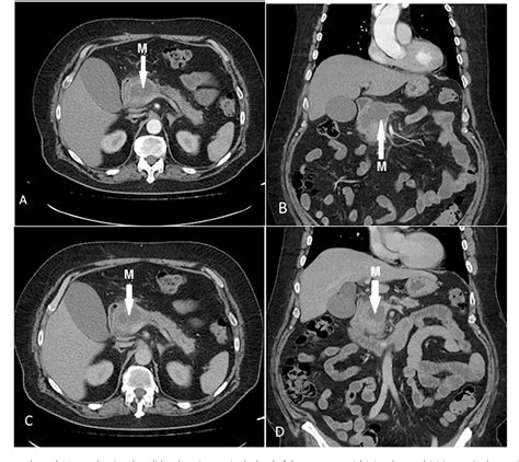 Figure 1 From Diabetic Ketoacidosis As The Presenting Manifestation Of