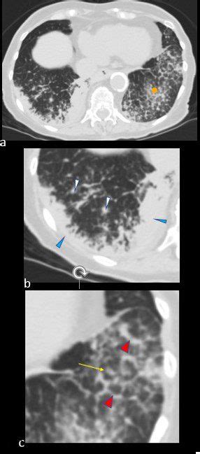 Nodules Centrilobular Lungs