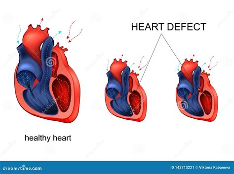 Heart Disease Defect Stock Vector Illustration Of Aorta 142713221