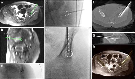 Percutaneous biopsy of a left iliac bone lesion in a 6-year-old boy ...