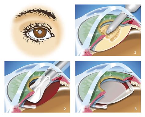 Treatment for Cataracts Burbank, CA | A Center for VisionCare