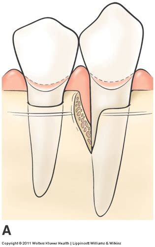 Perio Chapter 3 Overview Of Diseases Of The Periodontium Chapter 21