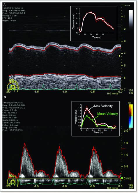 M Mode Echocardiographic Still Image Of Aortic Arch Diameter A And