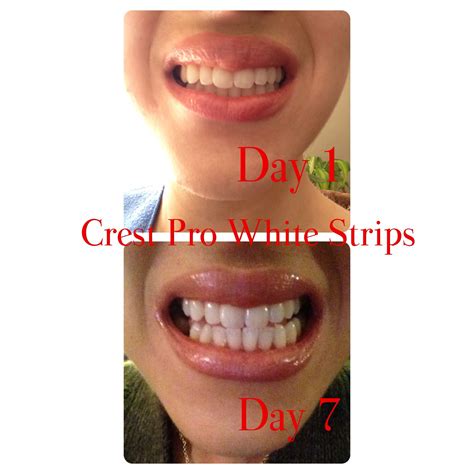 Crest 3d White Strips Before And After Pictures