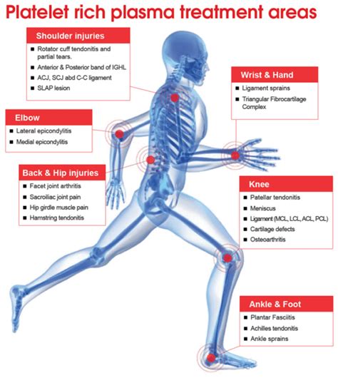 Why Get Prp Treatment Michigan Sports And Spine Center