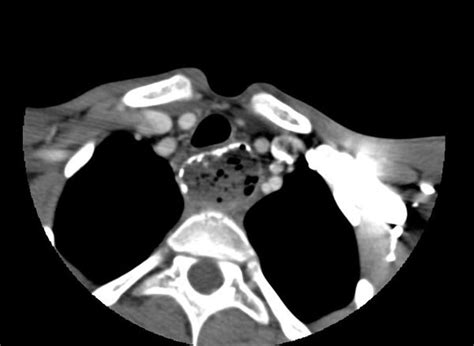 Achalasia Addisonian Syndrome Wikidoc