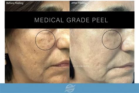 Medical Grade Peel Archives Olam Med Spa