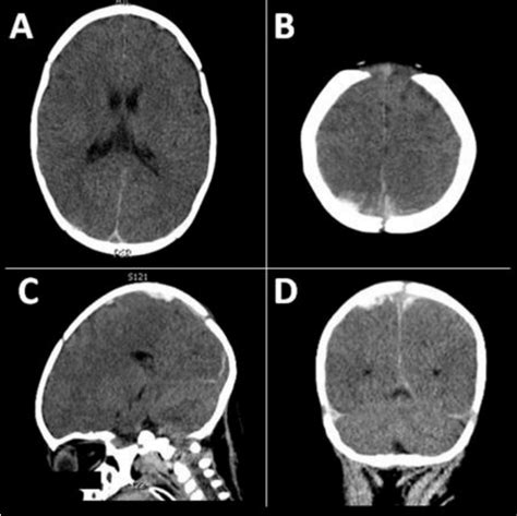 Non Enhanced Ct In Axial A And B Sagittal C And Coronal D