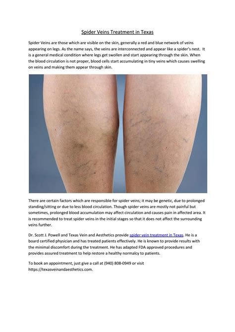 Spider Veins Treatment Texas by texasveindoctor - Issuu