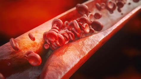 Arterioesclerosis qué es síntomas y tratamientos para esta enfermedad