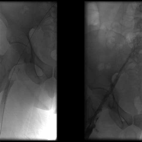 Left Right Lower Extremity Preintervention Venogram Middle Right