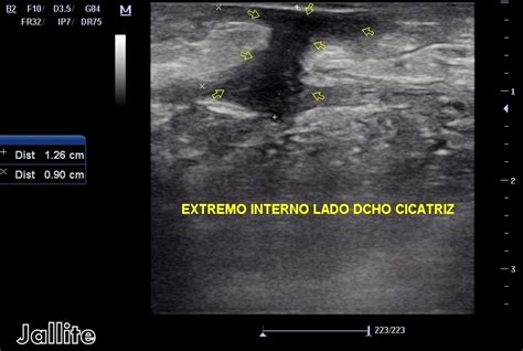 Granulomas Pared Abdominal