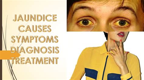 Jaundice Causes Sign Symptoms Treatment And Risk Factor YouTube