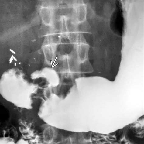 Peptic Ulcer X Ray