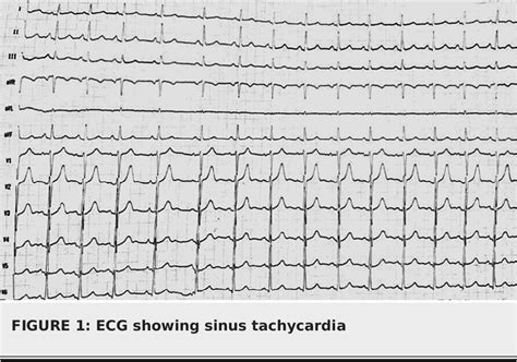 Figure 1 from A Case Report of a High-Altitude Acute Pulmonary Embolism ...