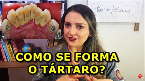 Como se forma tártaro nos dentes Como evitar YouTube