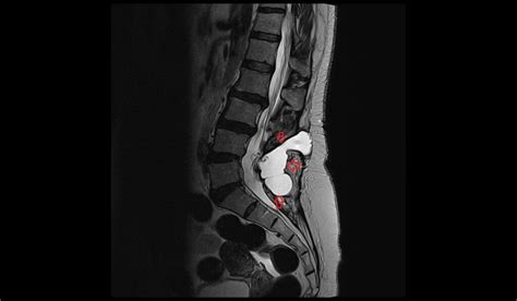 CSF leak MRI | Radiology article on CSF leak