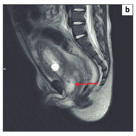 Sagittal T2 Weighted Magnetic Resonance Imaging Sequence Of The Lower