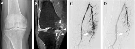 Genicular Artery Embolization For The Treatment Of Knee Pain Secondary