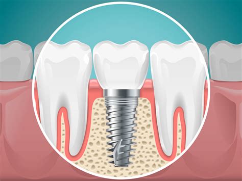 A complication that may occur with an implant crown - West Des Moines ...