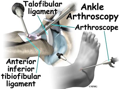 Ankle Impingement | eOrthopod.com