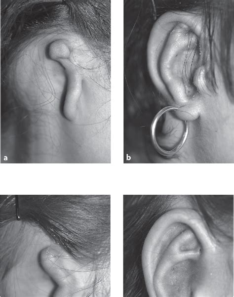 Figure 1 From State Of The Art Autogenous Ear Reconstruction In Cases