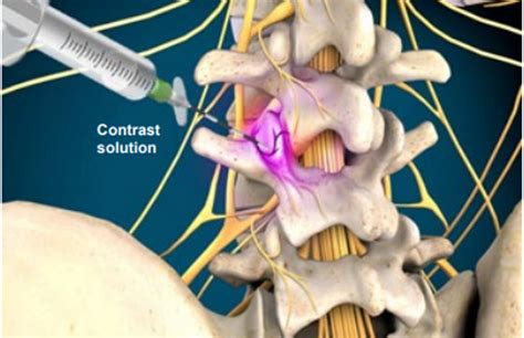 Lumbar Medial Branch Block Allen Mckinney Plano Frisco Dallas Tx