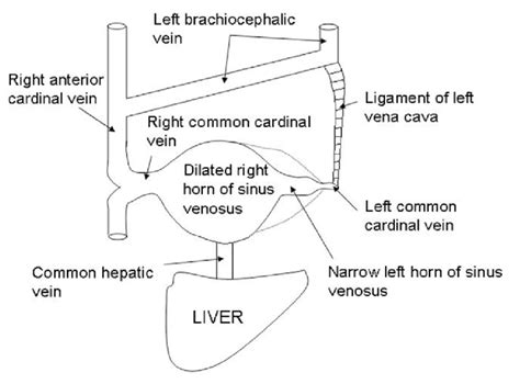 Diagram shows the formation of the left brachiocephalic vein. | Download Scientific Diagram