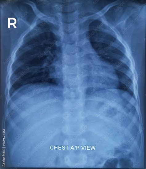 Pneumonitis(right), CXR (Chest X-Ray) PA view. Hypersensitivity pneumonitis. Stock Photo | Adobe ...