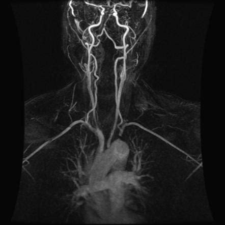 Vertebral Arterial Flow Reversal In Proximal Subclavian Artery