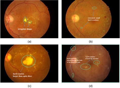 Examples of some difficulties in hard exudates segmentation, some hard ...