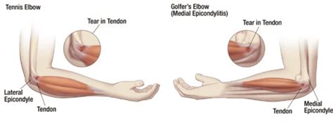 Elbow Epicondylitis, Epicondylosis | Sport & Spine Rehab