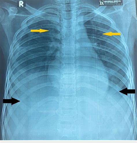 Portable Chest Radiograph Anterior Posterior A P View Showing Pleural