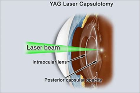 Post Cataract Operation India Treatment Of Acute Glaucoma Delhi Yag