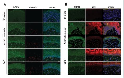 Figure 1 From Osteopontin Stimulates Preneoplastic Cellular