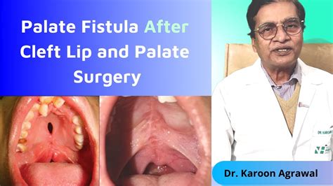 Palate Fistula After Cleft Lip And Palate Surgery Dr Karoon Agrawal