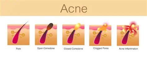 Comedone Clear Laser Mesaskinclinic