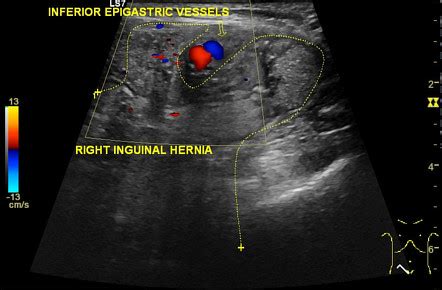 Pantaloon hernia | Radiology Case | Radiopaedia.org