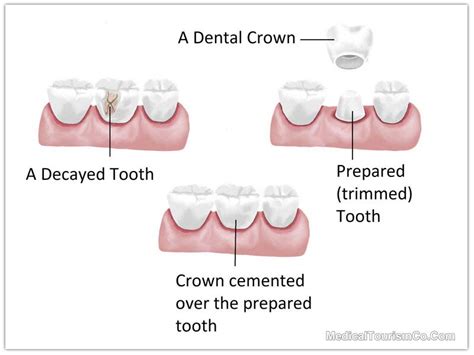 Dental Crowns in Costa Rica | Best Cost of Dental Caps in San Jose