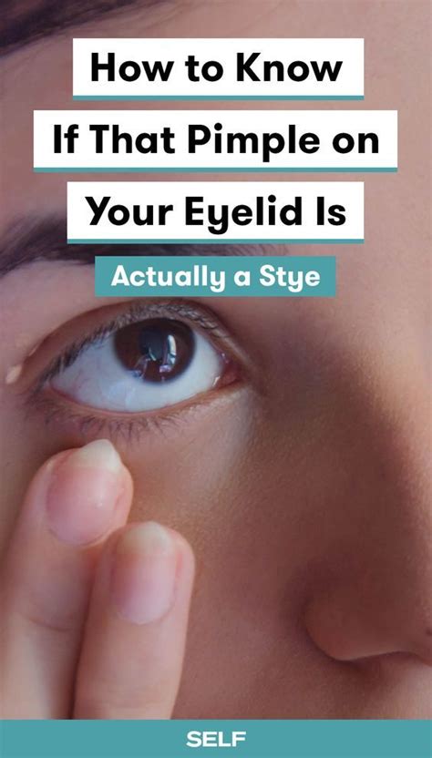 That Pimple on Your Eyelid Might Not Actually Be a Pimple | Pimples, Stye, How to know