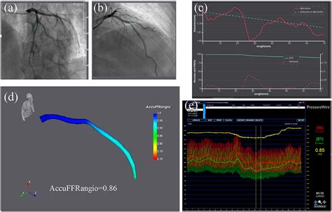 Qfr Technology For Advanced Coronary Artery Disease Leads Off