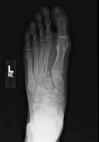 Lisfranc fracture - wikidoc