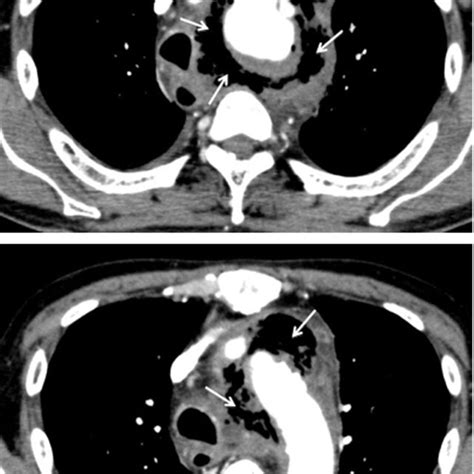 A Computed Tomography Reveals The Delayed Esophageal Perforation After